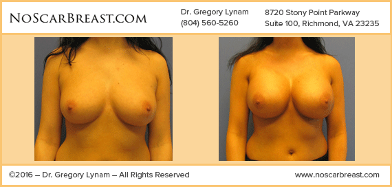 No Breast Scar Technique with 450cc Moderate Plus Saline Implants Richmond Case Study - Before and After Patient Result by Dr Lynam and NoBreastScar Team.