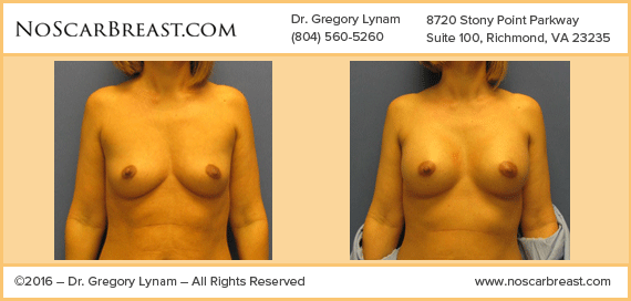 290cc Saline Transaxillary Enlargement Richmond Case Study - Before and After Patient Result by Dr Lynam and NoBreastScar Team.