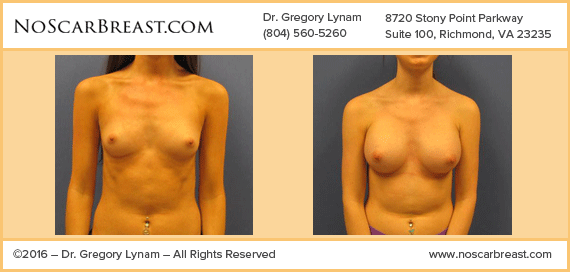 Transaxillary 320cc Saline Implants Richmond Case Study - Before and After Patient Result by Dr Lynam and NoBreastScar Team.