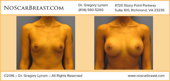 Saline Breast Enlargement with a “no breast scar” Technique with an Endoscopic Trans Axillary Breast Augmentation Richmond Case Study - Before and After Patient Result by Dr Lynam and NoBreastScar Team.